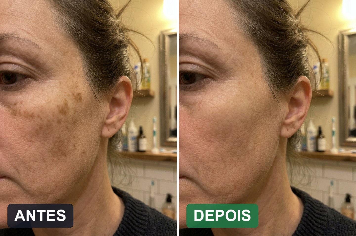 Antes e depois 1: a pele com manchas e a pele depois de usar a Derma Pro
