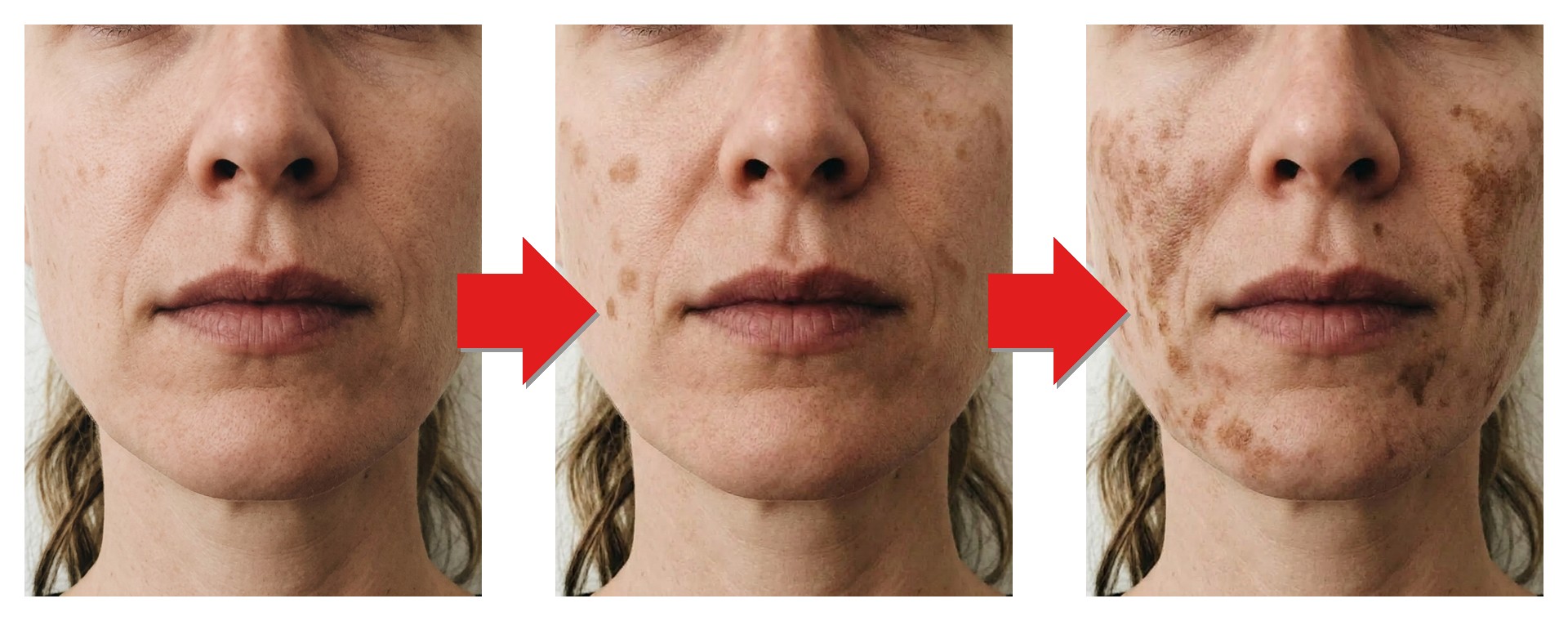 Evolução das manchas no rosto: manchas ligeiras, manchas médias e manchas escuras