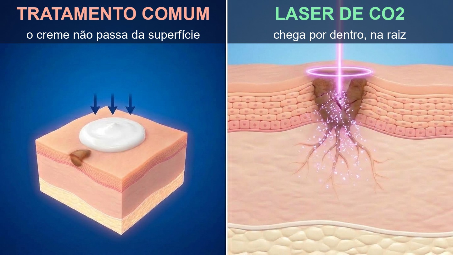 Comparativo em 3D: o tratamento comum não passa da superfície, o laser de CO2 chega por dentro, à raiz da mancha